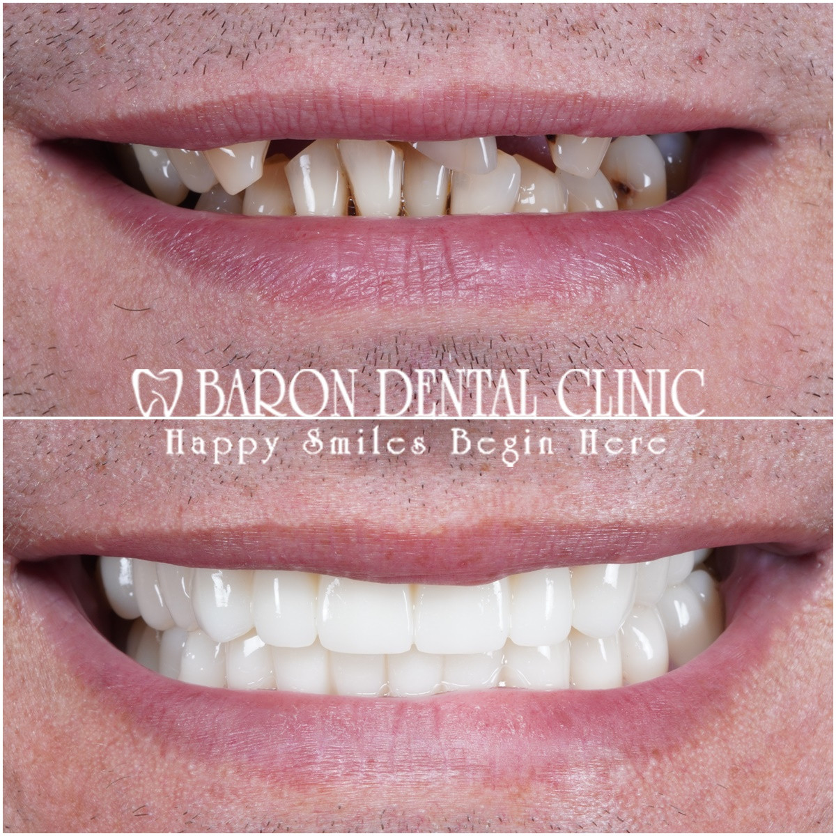 Baron Dental Clinic - Dental Tourism Antalya – Fotoğraf 2
