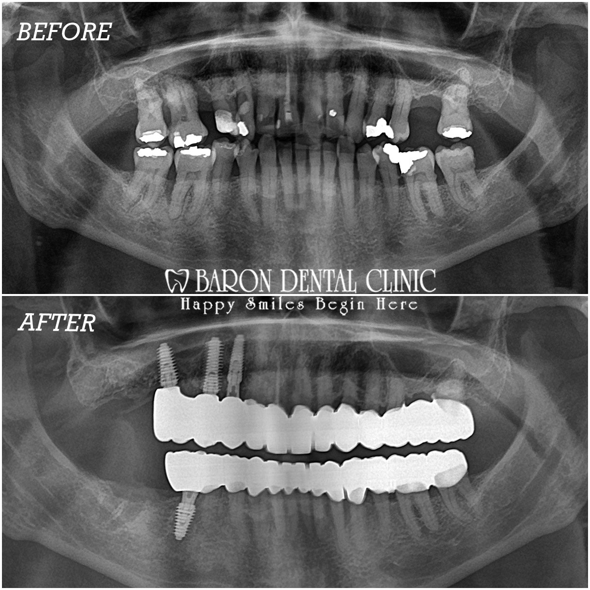 Baron Dental Clinic - Dental Tourism Antalya – Fotoğraf 3
