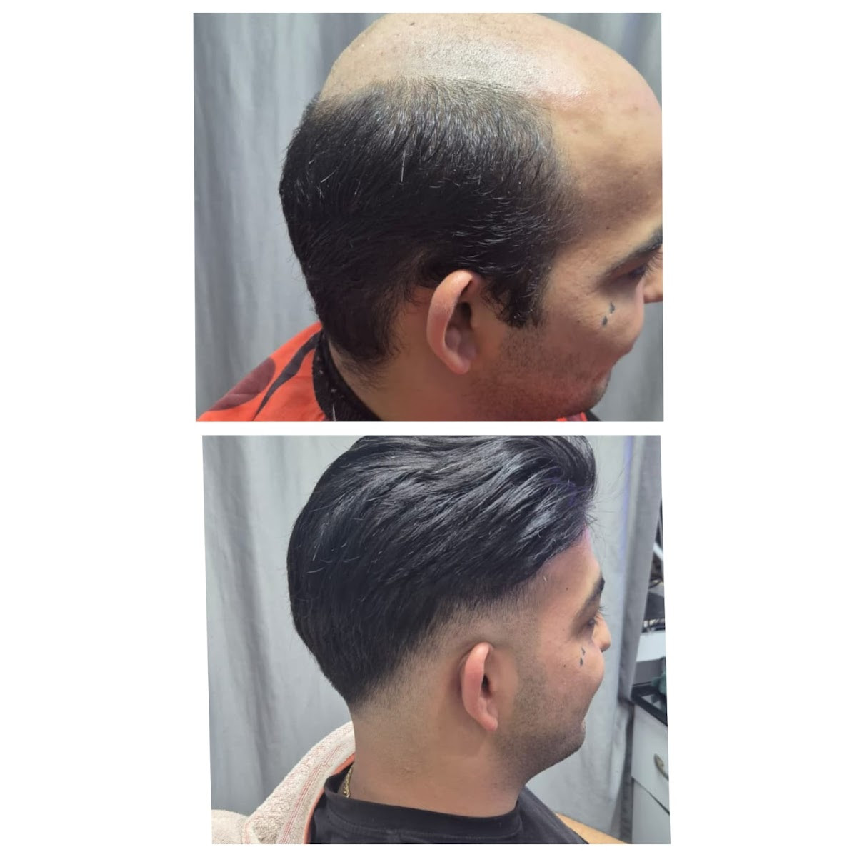 Manavgat Protez Saç – Fotoğraf 2