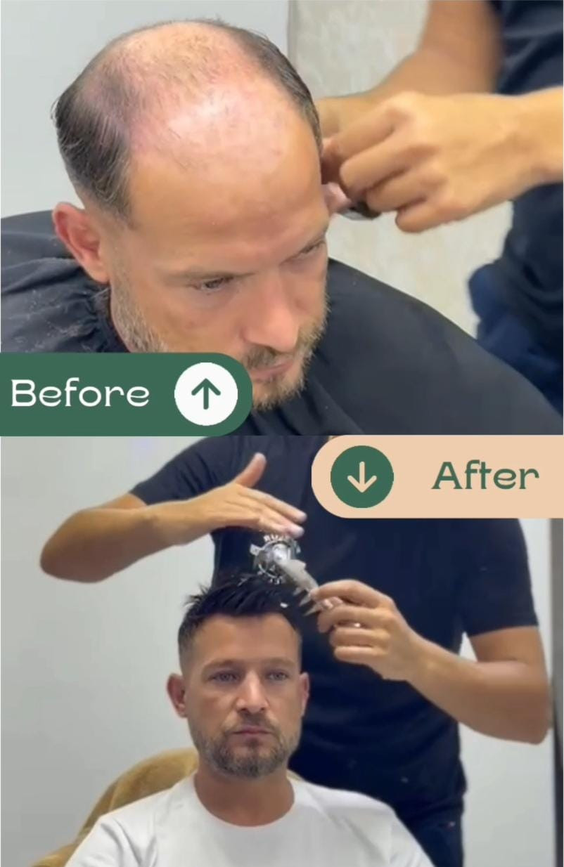 Manavgat Protez Saç – Fotoğraf 5