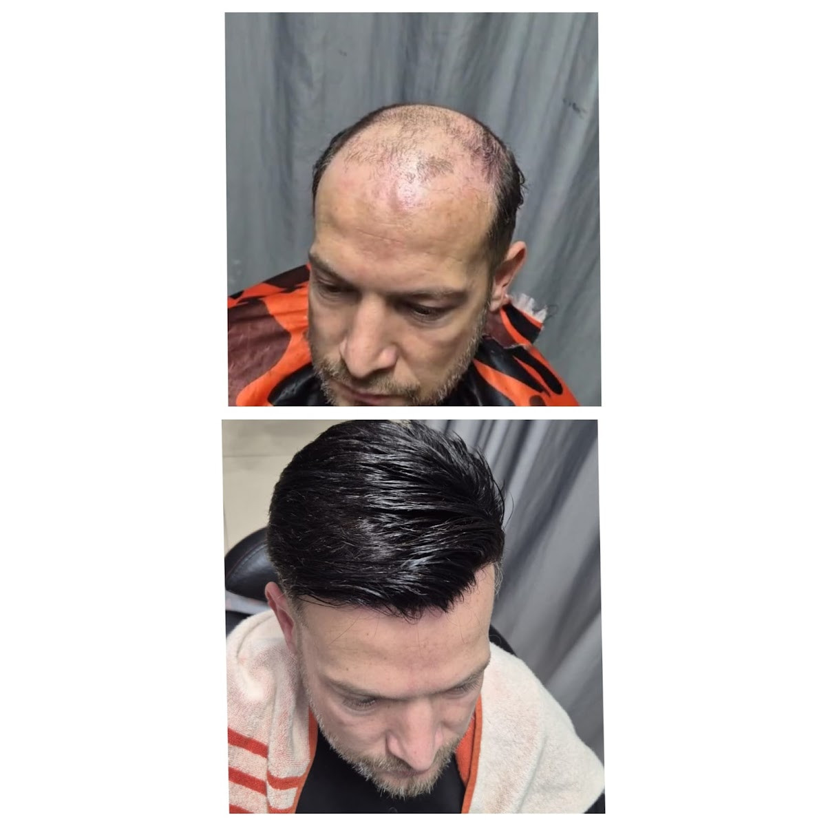 Manavgat Protez Saç – Fotoğraf 3