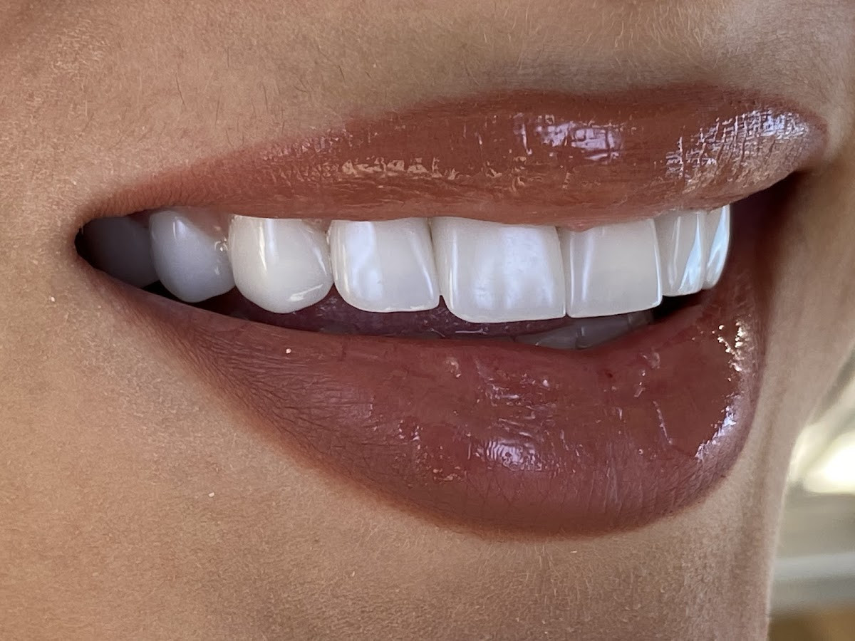 Side Smile Center (Dt.Mustafa Yunusoğlu) Side Dental Clinic Side zahnklinik – Fotoğraf 5