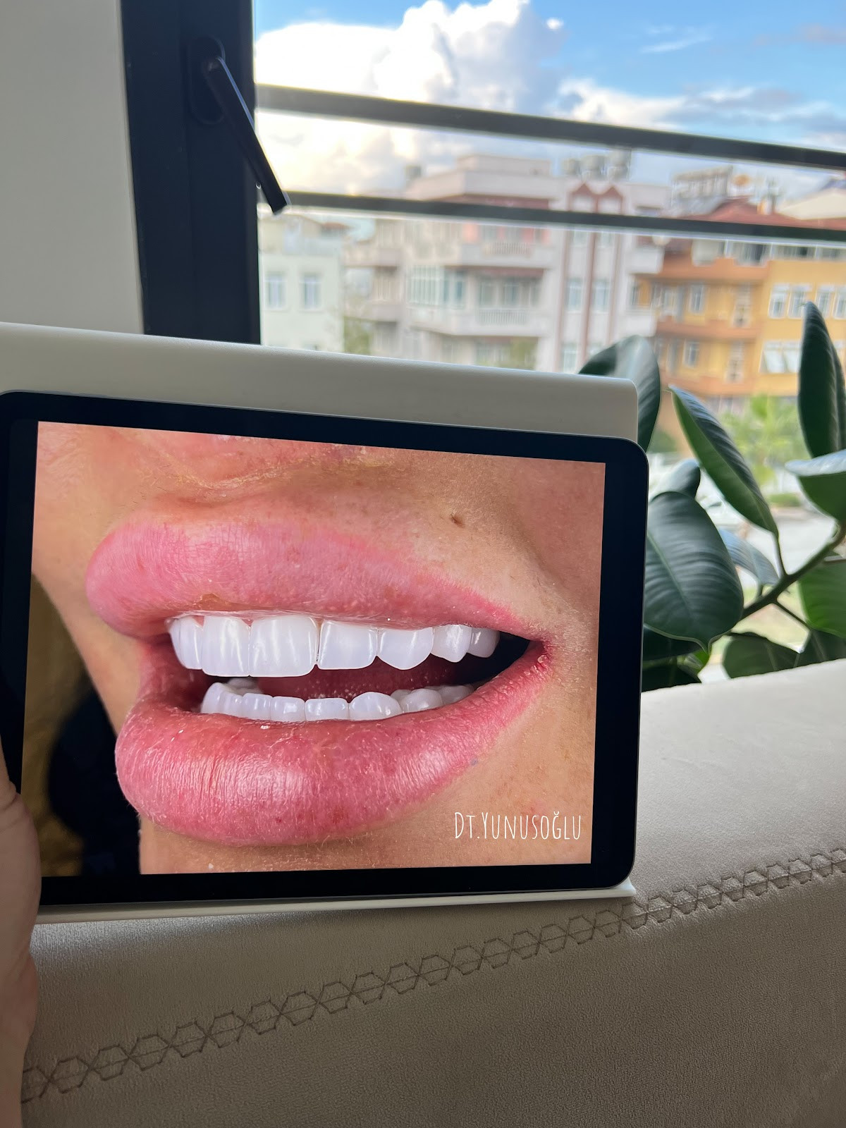 Side Smile Center (Dt.Mustafa Yunusoğlu) Side Dental Clinic Side zahnklinik – Fotoğraf 8