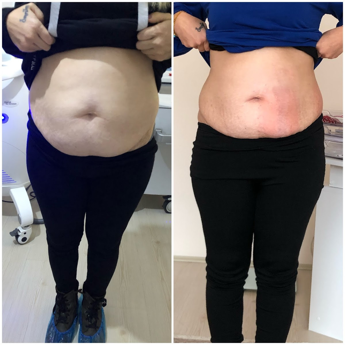 Sorgun Lazer Epilasyon Ve Güzellik Merkezi – Fotoğraf 6